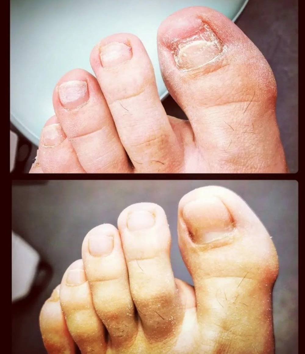 pedicure-avant-apres