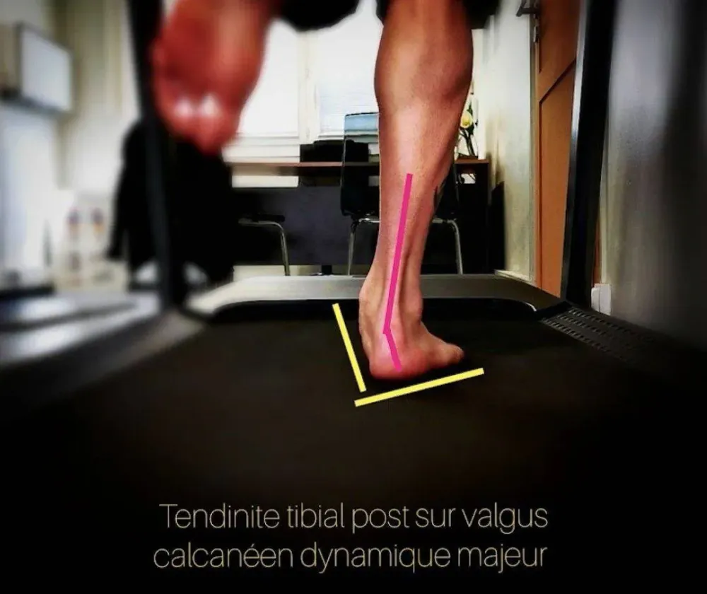 Semelles orthopédiques-40webp
