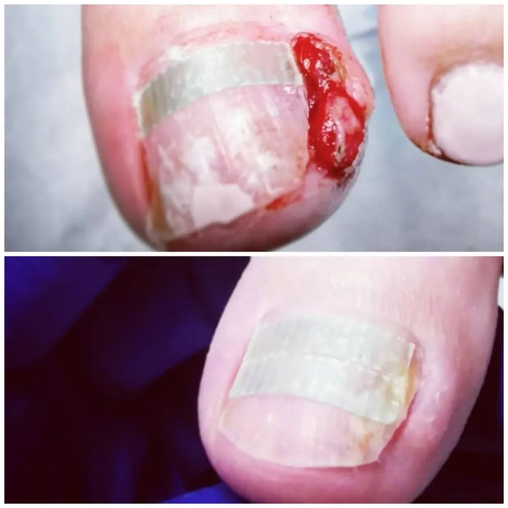 orthoplasties-orthonyxies-contentions-nocturnes-pour-hallux-valgus-onychoplasties-4
