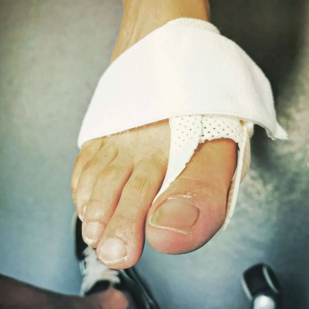 orthoplasties-orthonyxies-contentions-nocturnes-pour-hallux-valgus-onychoplasties-5