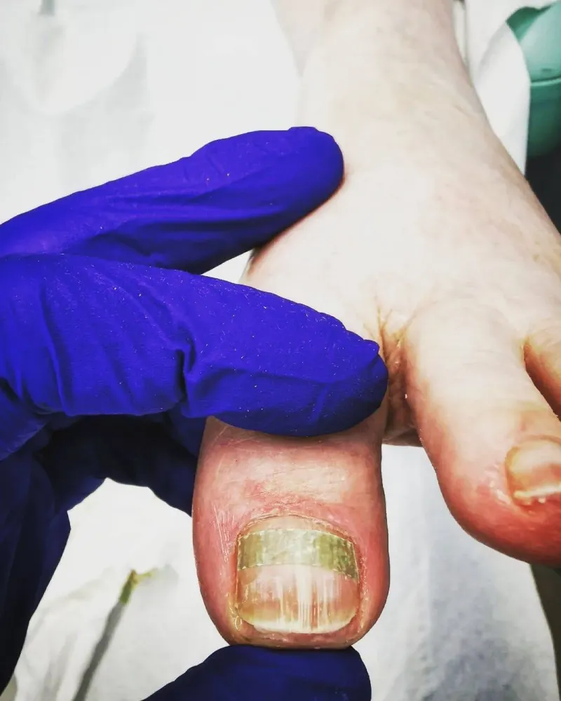 orthoplasties-orthonyxies-contentions-nocturnes-pour-hallux-valgus-onychoplasties-6
