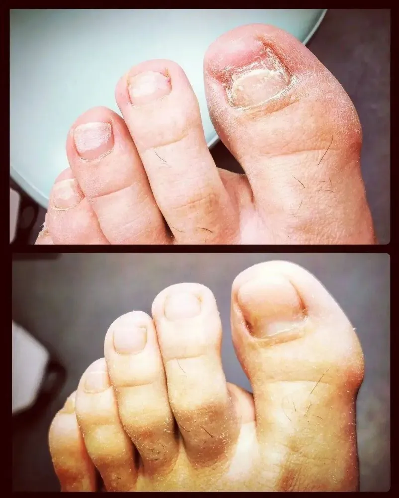 orthoplasties-orthonyxies-contentions-nocturnes-pour-hallux-valgus-onychoplasties-7