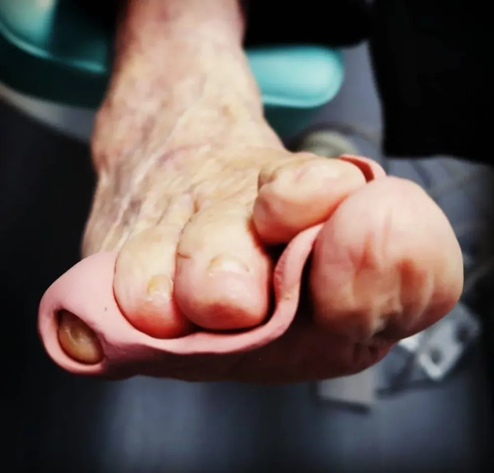 orthoplasties-orthonyxies-contentions-nocturnes-pour-hallux-valgus-onychoplasties-8