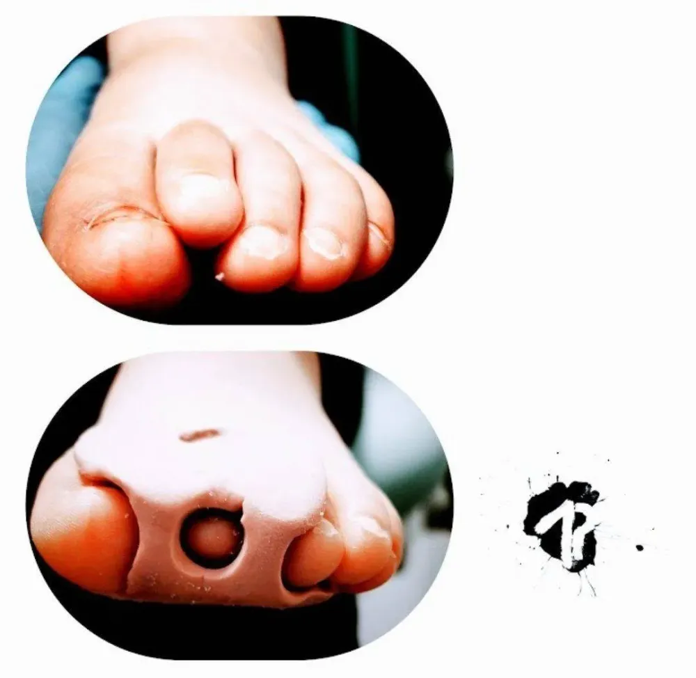 orthoplasties-orthonyxies-contentions-nocturnes-pour-hallux-valgus-onychoplasties-9