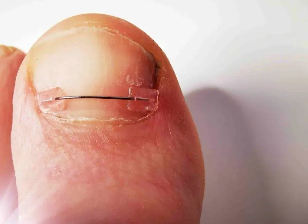 orthoplasties-orthonyxies-contentions-nocturnes-pour-hallux-valgus-onychoplasties-10