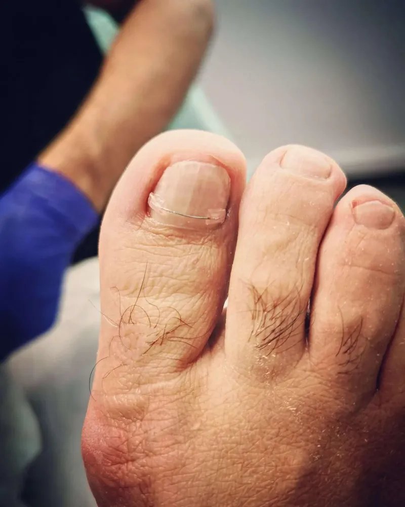 orthoplasties-orthonyxies-contentions-nocturnes-pour-hallux-valgus-onychoplasties-2