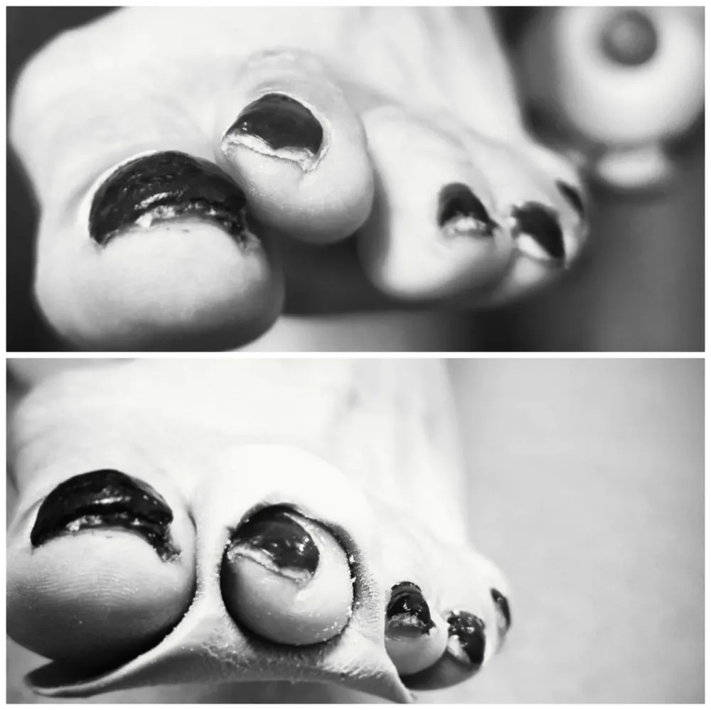 orthoplasties-orthonyxies-contentions-nocturnes-pour-hallux-valgus-onychoplasties-3